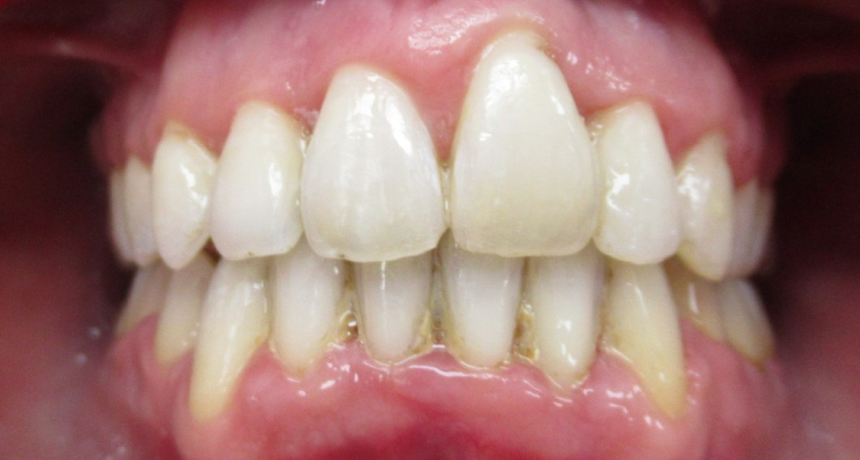 Traitement par appareils dentaires Orthodontiste spécialiste à Paris 18, Dr Mehdi Sersab