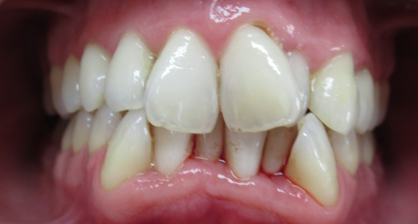 Traitement par appareils dentaires Orthodontiste spécialiste à Paris 18, Dr Mehdi Sersab