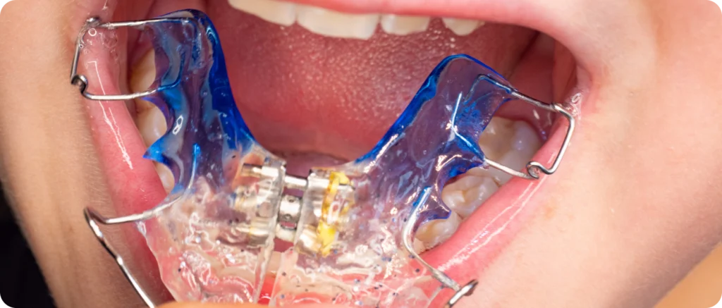 Quand consulter un orthodontiste pour son enfant ? Orthodontiste spécialiste à Paris 18, Dr Mehdi Sersab