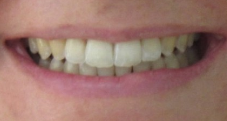 Traitement par gouttières invisibles Orthodontiste spécialiste à Paris 18, Dr Mehdi Sersab