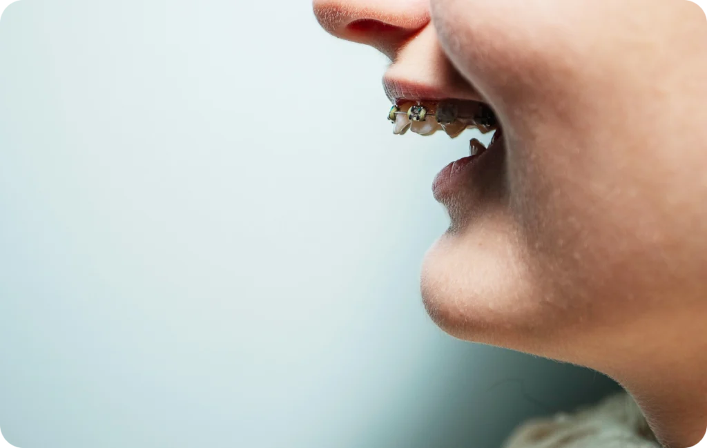 Traitements ortho-chirurgicaux Orthodontiste spécialiste à Paris 18, Dr Mehdi Sersab