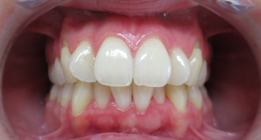 Traitement par gouttières invisibles Orthodontiste spécialiste à Paris 18, Dr Mehdi Sersab