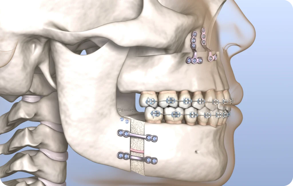Traitements ortho-chirurgicaux Orthodontiste spécialiste à Paris 18, Dr Mehdi Sersab