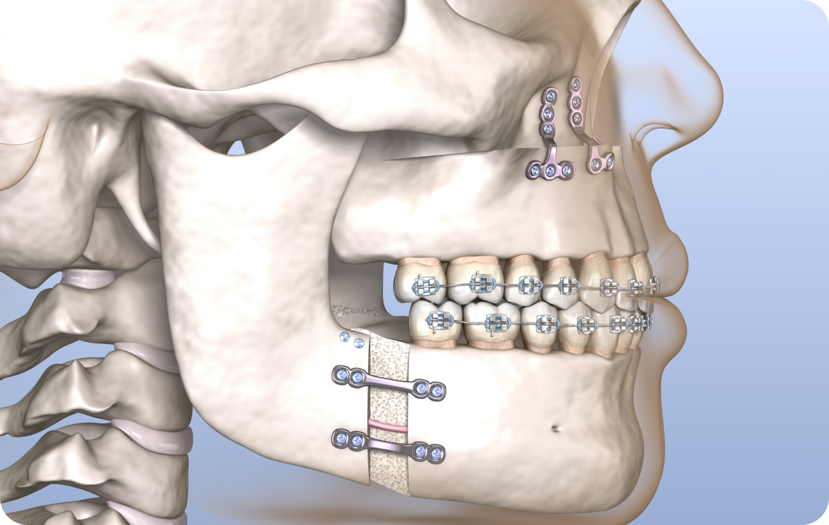 Traitements ortho-chirurgicaux Orthodontiste spécialiste à Paris 18, Dr Mehdi Sersab
