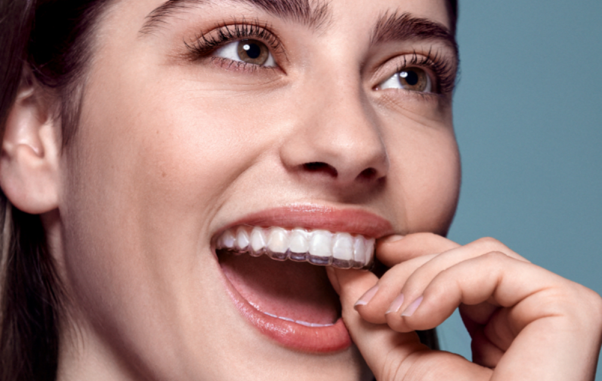 Aligneurs transparents Orthodontiste spécialiste à Paris 18 | Dr Mehdi Sersab