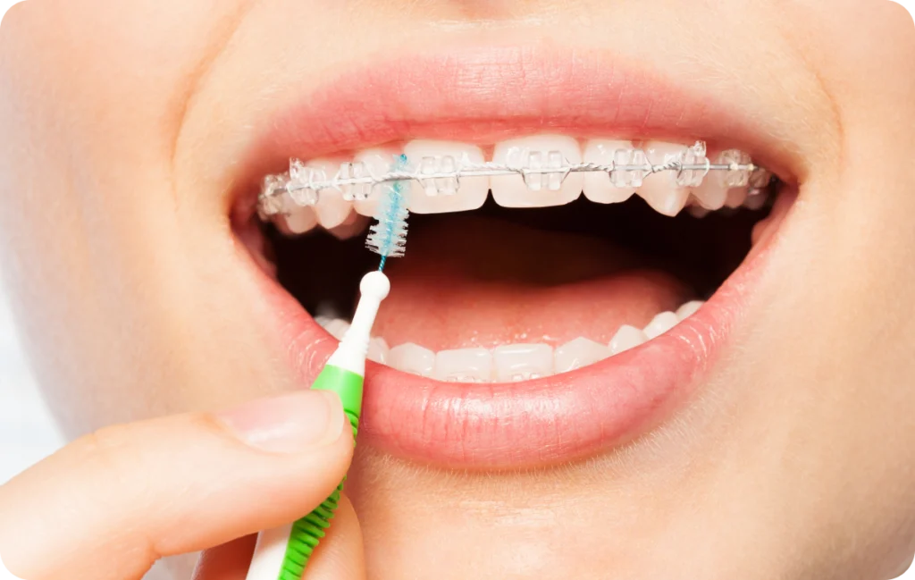 Appareils dentaires Orthodontiste spécialiste à Paris 18, Dr Mehdi Sersab