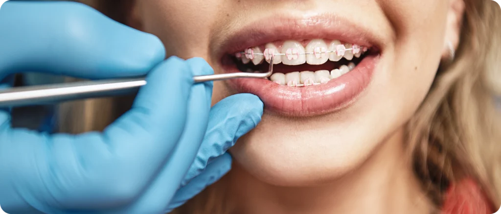 Appareils dentaires Orthodontiste spécialiste à Paris 18, Dr Mehdi Sersab