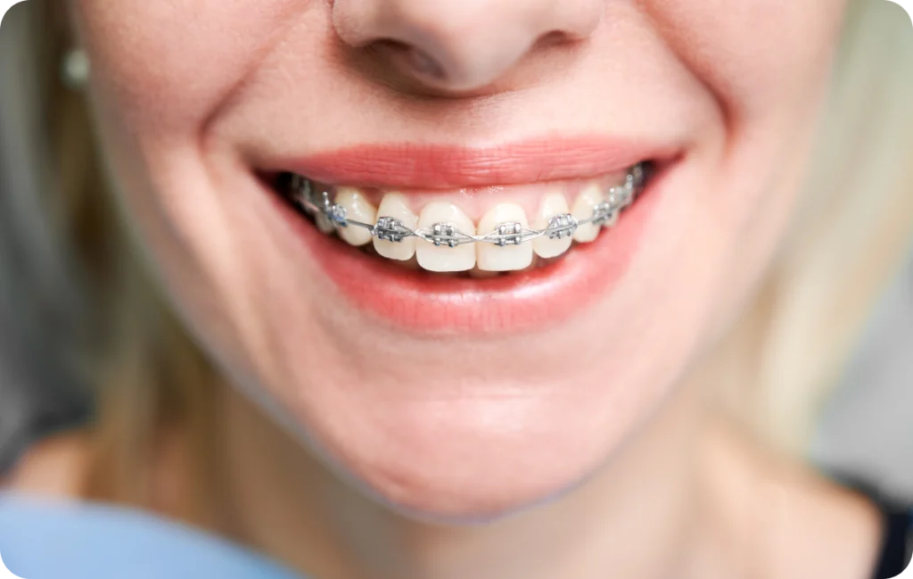 Appareils dentaires Orthodontiste spécialiste à Paris 18, Dr Mehdi Sersab