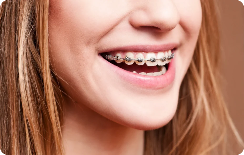 Appareils dentaires Orthodontiste spécialiste à Paris 18 | Dr Mehdi Sersab