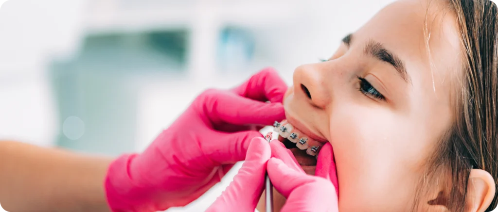 Appareils dentaires Orthodontiste spécialiste à Paris 18 | Dr Mehdi Sersab