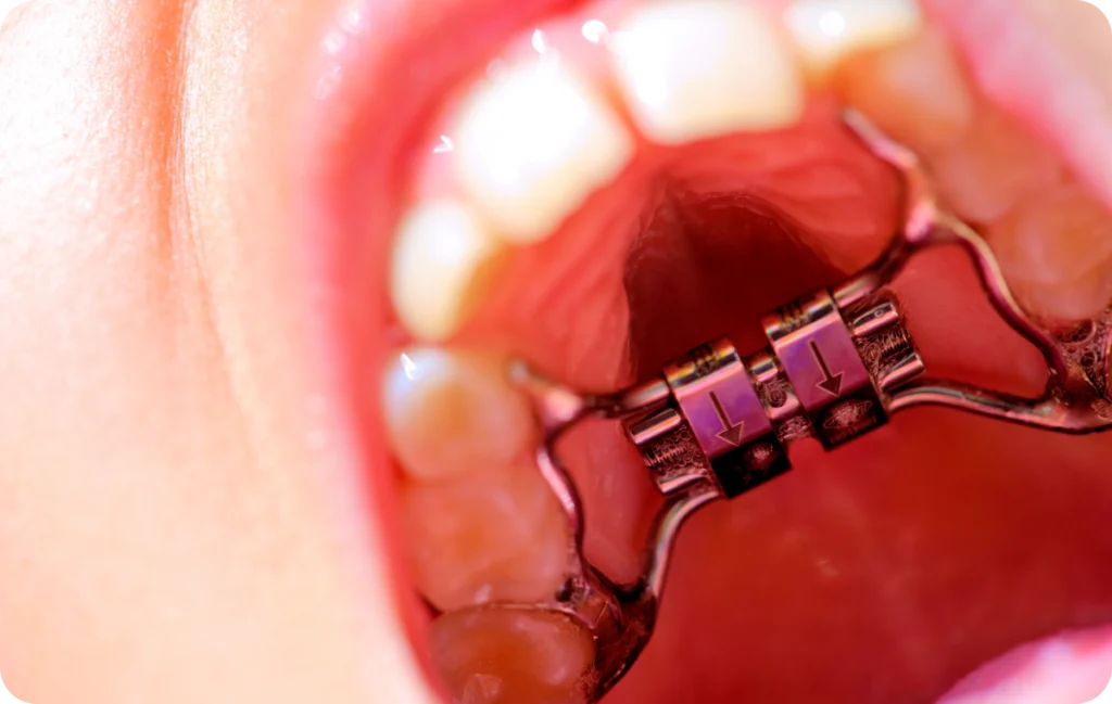 Expansion maxillaire et disjonction palatine chez l’enfant Orthodontiste spécialiste à Paris 18 | Dr Mehdi Sersab