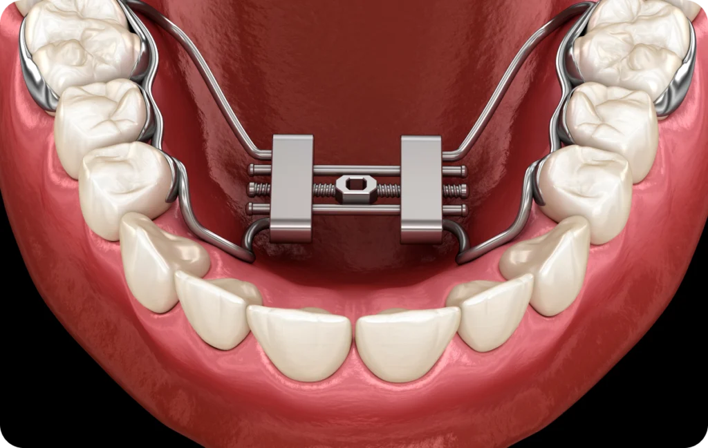 Expansion maxillaire et disjonction palatine chez l’enfant Orthodontiste spécialiste à Paris 18 | Dr Mehdi Sersab