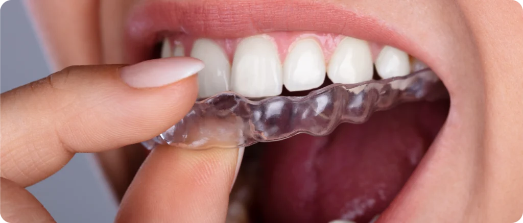 Aligneurs transparents Orthodontiste spécialiste à Paris 18 | Dr Mehdi Sersab