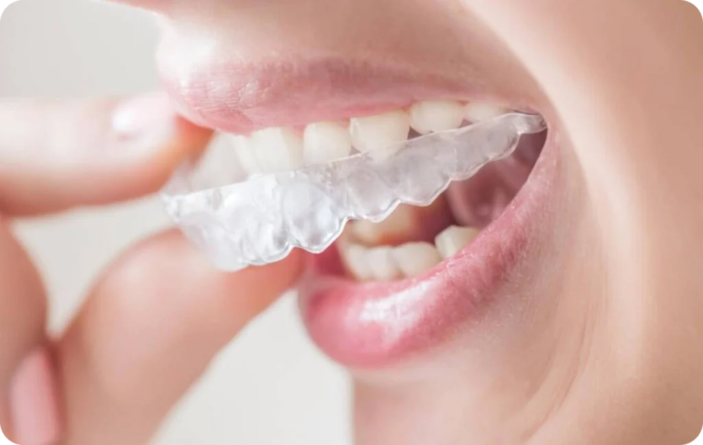 Aligneurs transparents Orthodontiste spécialiste à Paris 18 | Dr Mehdi Sersab