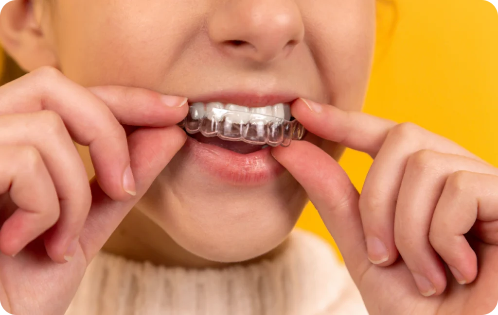 Gouttières transparentes Orthodontiste spécialiste à Paris 18, Dr Mehdi Sersab